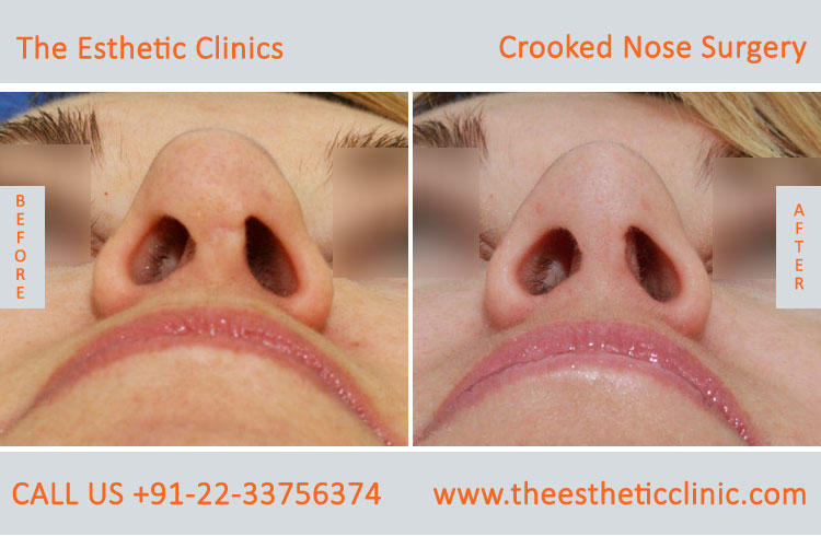 Crooked Nose Surgery before after photos in mumbai india (4)